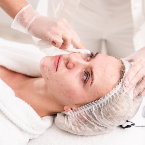 Acne-Facial-Summit-Bodyworks-At-Foothills-Knoxville-TN